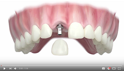 Implantat Kosten: Video Video zur Behandlung mit und den Kosten von Implantaten